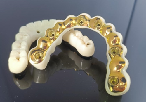 CAD/CAM titanium implantaatstaaf+zirkoniabrug