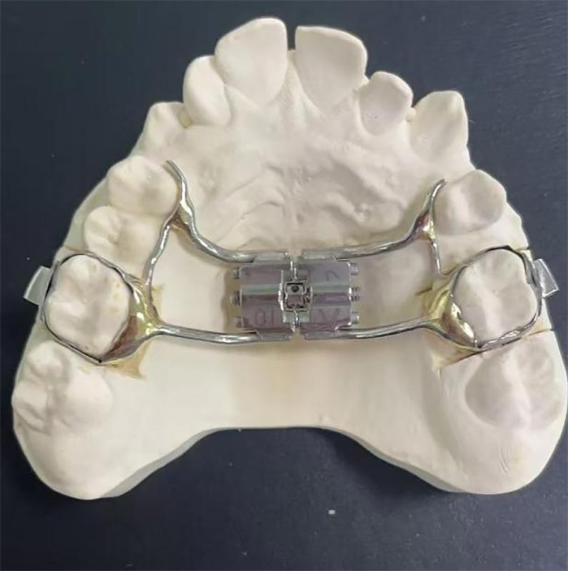 Wat is een snelle maxillaire expander (RME)?