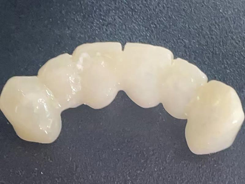 Wat is een ‘tijdelijke kroon’? Waarom heb je er een nodig?