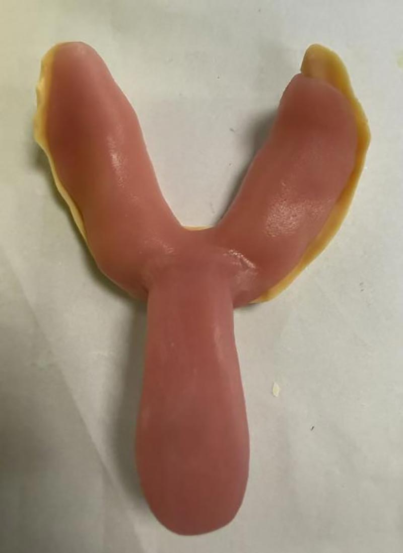 Dingen die u niet wist over op maat gemaakte tandheelkundige trays