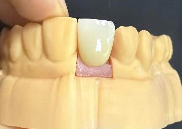 De openingen tussen de tanden kunnen worden gerepareerd; rechte tanden zijn het aantrekkelijkst!