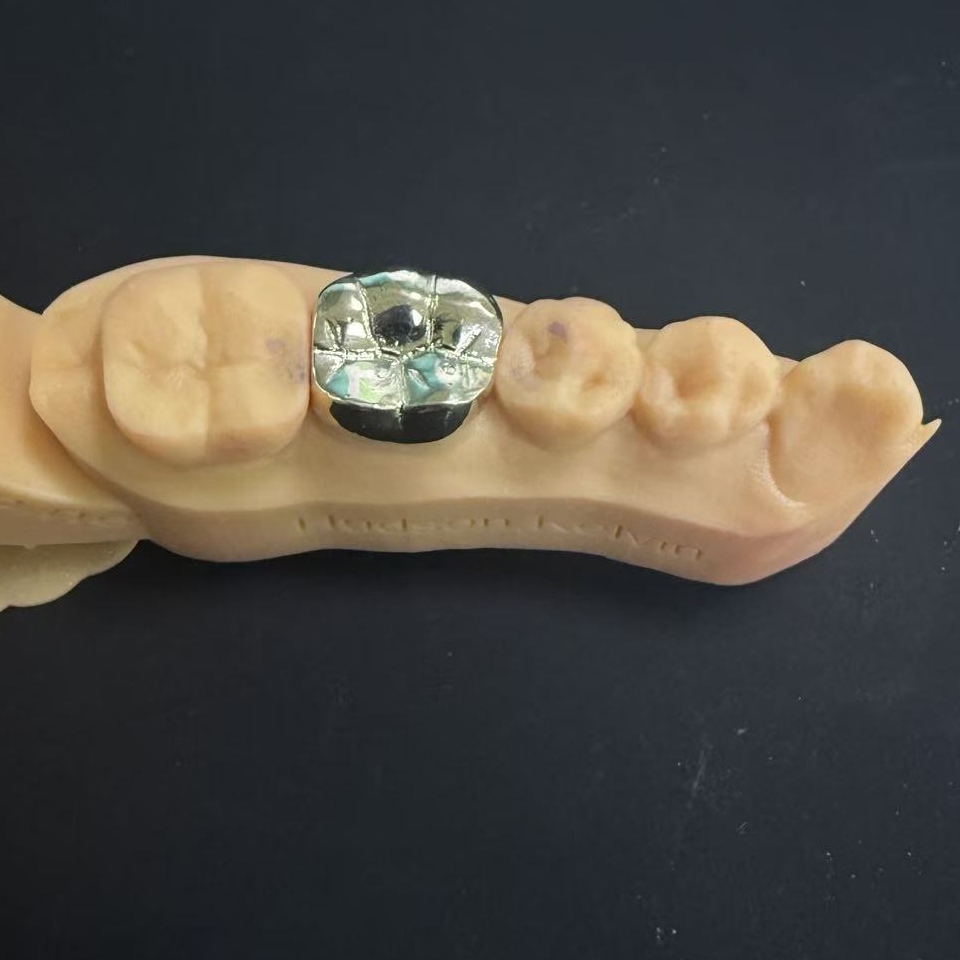 Gouden kronen: de keuze van edelmetaal voor levenslange tandrestauratie