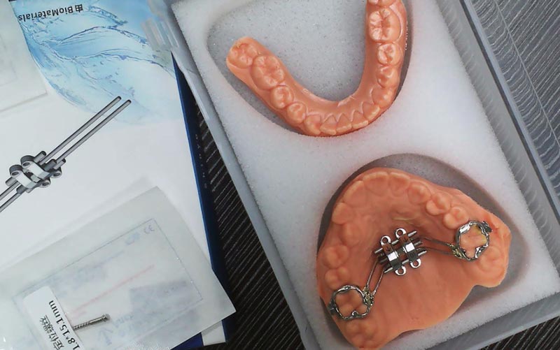 Begrijp de uitbreiding van het MSE-skelet met WM Dental Lab