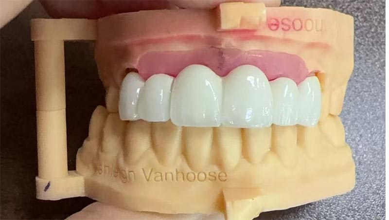 Zwarte driehoeken bij orthodontische behandelingen