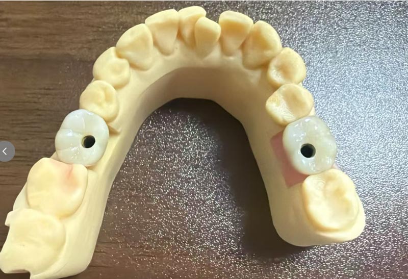Waarom is implantatie van de voorste tand moeilijker dan implantatie van de achterste tand?