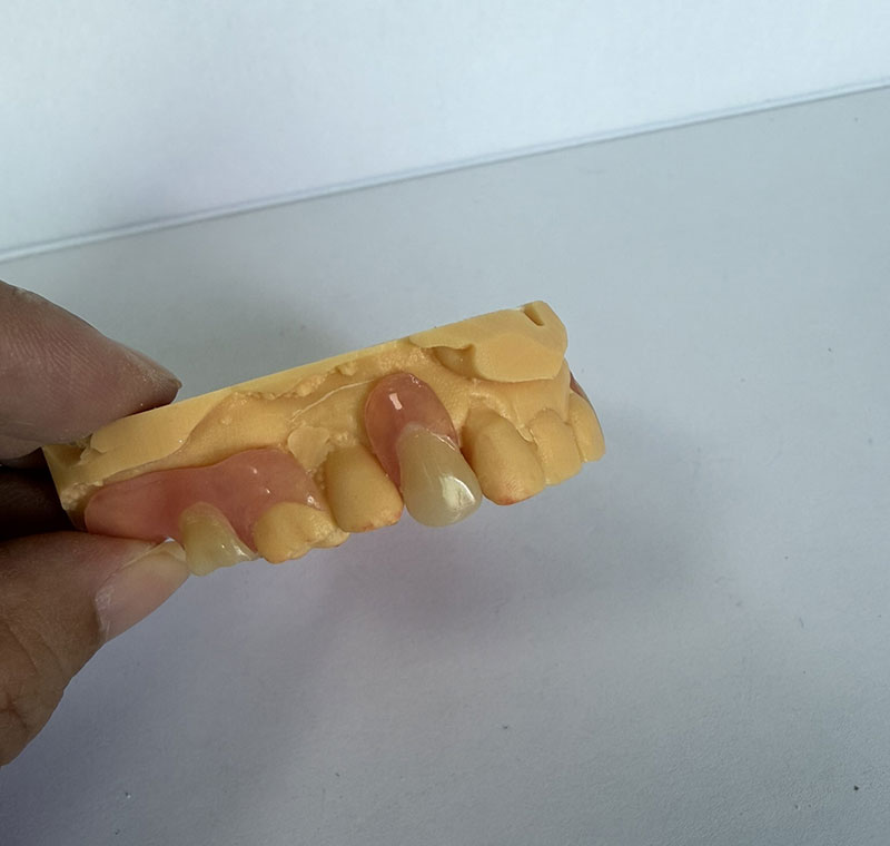 Valplast Partials bij WM Dental Lab