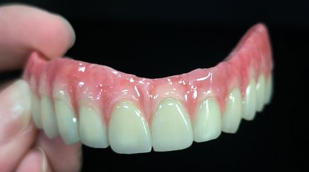 Alles op 4 Hybrid - Malo Bridge volledige zirkonia kronen over titaniumstructuur