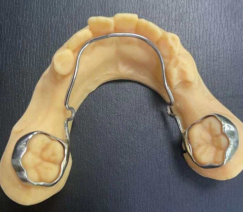 mandibular lingual arch retainer
