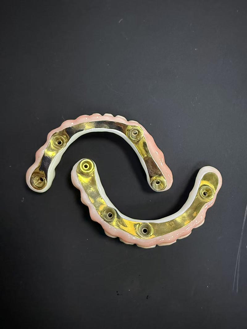bar-clip implant-retained