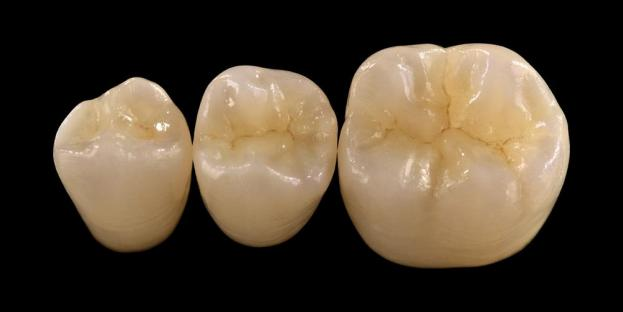<h2>Zirkonia in de tandheelkunde: indicaties, voordelen en klinische overwegingen</h2>
<p>Zirkonia wordt algemeen erkend vanwege zijn sterkte en duurzaamheid. De nieuwste generaties zirkonia-materialen bieden ook aanzienlijk verbeterde esthetische eigenschappen. Voor patiënten die volledig keramische restauraties overwegen, is het essentieel om zowel de indicaties als de beperkingen van op zirkoniumoxide gebaseerde systemen zorgvuldig te evalueren.</p>
<p>De patiënten van vandaag verwachten steeds vaker restauraties die uitstekende esthetiek combineren met volledige functionele prestaties. De meeste moderne keramische systemen kunnen aan deze verwachtingen voldoen, maar klinisch succes hangt grotendeels af van de juiste materiaalkeuze, tandpreparatie en cementatieprotocollen. De keuze moet worden geleid door belangrijke materiaaleigenschappen zoals breukweerstand, buigsterkte, slijtvastheid en stabiliteit op lange termijn. Van deze materialen is zirkonia een van de meest gebruikte opties geworden in de hedendaagse restauratieve tandheelkunde.</p>
<h3>Waarom kiezen voor zirkonia?</h3>
<p>Zirkonia wordt gewaardeerd om zijn uitzonderlijke sterkte en duurzaamheid op lange termijn. Moderne zirkonia verschilt aanzienlijk van eerdere generaties, die ondoorzichtiger en minder esthetisch waren. Tegenwoordig maakt CAD/CAM-technologie een nauwkeurige vervaardiging van zirkoniumoxiderestauraties met verbeterde optische eigenschappen mogelijk.</p>
<p>Restauraties kunnen worden ontworpen als:</p>
<ul>
<li><strong>Monolithische zirkonia:</strong>Ideaal voor posterieure kronen en bruggen en biedt hoge sterkte en duurzaamheid.</li>
<li><strong>Gelaagde zirkonia:</strong>Geschikt voor gevallen die een verbeterde esthetiek vereisen, inclusief grote restauraties over verschillende delen van de mond.</li>
</ul>
<p>De buigsterkte varieert afhankelijk van het type, variërend van ongeveer 590 MPa in zirkoniumoxide met hoge doorschijnendheid tot maximaal 1400 MPa in monolithische vormen. Zirkoniumoxiderestauraties kunnen worden gecementeerd met zelfhechtende harscementen of met hars gemodificeerde glasionomeercementen.</p>
<h3>Sleutelfactoren bij de materiaalkeuze van zirkoniumoxide</h3>
<p>Bij het overwegen van zirkoniumoxide voor een volledig keramische restauratie moeten artsen verschillende kritische factoren evalueren:</p>
<ul>
<li>Resterende tandstructuur</li>
<li>Locatie in de mondholte (esthetische zone versus functionele zone)</li>
<li>Aanwezigheid van parafunctionele gewoonten zoals bruxisme</li>
<li>Doorschijnendheid van aangrenzende natuurlijke tanden</li>
<li>Kleur en toestand van de onderliggende tandstructuur</li>
</ul>
<p>De esthetische zone omvat doorgaans de voorste tanden, hoewel deze zich bij sommige patiënten kan uitstrekken tot de eerste kies, afhankelijk van de glimlachlijn en de gezichtsdynamiek. De functionele zone omvat over het algemeen premolaren en kiezen, waar de occlusale krachten aanzienlijk hoger zijn.</p>
<h3>Functionele zonetoepassingen</h3>
<p>In de achterste gebieden moeten de occlusale krachten zorgvuldig in overweging worden genomen. Zirkonia is een uitstekend alternatief voor traditionele PFM-restauraties, vooral in gevallen met beperkte restauratieruimte. Modern monolithisch zirkonia maakt een volledig contourontwerp van de occlusale anatomie mogelijk, inclusief functionele knobbels en marginale randen, terwijl de hoge sterkte behouden blijft.</p>
<p>Uit actueel bewijsmateriaal blijkt dat monolithisch zirkoniumoxide zeer geschikt is voor achterste kronen en bruggen met meerdere eenheden vanwege de uitstekende weerstand tegen breuk en slijtage. Vooruitgang op het gebied van adhesieve technieken en het ontwerp van preparaten hebben ook de klinische resultaten op de lange termijn verbeterd.</p>
<h3>Esthetische Zone-toepassingen</h3>
<p>In het voorste gebied moeten restauraties de natuurlijke tandkleur, doorschijnendheid en lichtgedrag nauwkeurig nabootsen. Hoewel materialen zoals lithiumdisilicaat een uitstekende esthetiek bieden, zijn ze minder sterk en vereisen ze doorgaans lijmverbindingen.</p>
<p>Een belangrijk voordeel van zirkoniumoxide is dat het op conventionele wijze kan worden gecementeerd, terwijl toch hoge esthetische prestaties worden bereikt. Met de ontwikkeling van systemen met hoge translucentie en meerlaagse zirkoniumoxide is het nu mogelijk restauraties te produceren die het natuurlijke gebit nauw nabootsen.</p>
<p>Geavanceerde verwerkingstechnieken verbeteren de optische eigenschappen verder en verminderen onvolkomenheden die de lichttransmissie en het uiterlijk kunnen beïnvloeden.</p>
<h3>Kracht en esthetiek gecombineerd</h3>
<p>Vroege zirkoniumoxidesystemen gaven prioriteit aan sterkte, maar misten esthetische kwaliteit. Modern monolithisch zirkonia combineert met succes zowel sterkte als een verbeterd uiterlijk, waardoor het geschikt is voor een breed scala aan klinische gevallen.</p>
<p>Het is vooral gunstig voor patiënten met parafunctionele gewoonten of eerdere mislukte restauraties. Klinische onderzoeken wijzen op een hoge patiëntacceptatie en lage complicaties.</p>
<p>Zorgen over slijtage van het tegenoverliggende gebit zijn verminderd met nieuwere formuleringen. Hooggepolijste zirkonia-oppervlakken vertonen een laag schuurpotentieel en kunnen in sommige gevallen zachter zijn dan traditionele porselein-op-metaal restauraties.</p>
<h3>Zirkonia-implantaten: opkomend alternatief</h3>
<p>Terwijl titaniumimplantaten de klinische standaard blijven, krijgen zirkoniumimplantaten steeds meer aandacht als metaalvrij alternatief. Vroege ontwerpen waren voornamelijk systemen uit één stuk, maar tweedelige zirkoniumimplantaten zorgen nu voor verbeterde prothetische flexibiliteit.</p>
<p>Zirkonia-implantaten zijn met name nuttig in gevallen waarin esthetische problemen bestaan, zoals mogelijke grijze verkleuring van peri-implantaatweefsel of een dun gingivaal biotype. Ze kunnen ook worden overwogen voor patiënten met een zeldzame gevoeligheid voor titanium.</p>
<p>Zirkonia-implantaten zijn echter nog relatief nieuw en de klinische gegevens over de lange termijn blijven beperkt in vergelijking met titaniumsystemen.</p>
<h3>Conclusie</h3>
<p>Zirkonia is uitgegroeid tot een zeer veelzijdig materiaal in de restauratieve tandheelkunde, dat een sterke balans biedt tussen mechanische prestaties en esthetiek. Een juiste casusselectie en naleving van klinische protocollen zijn essentieel voor het bereiken van optimale resultaten bij zowel anterieure als posterieure toepassingen.</p>