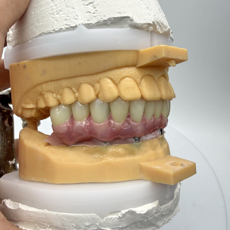 Malo Bridge met Meharry Gum voor zwarte mensen